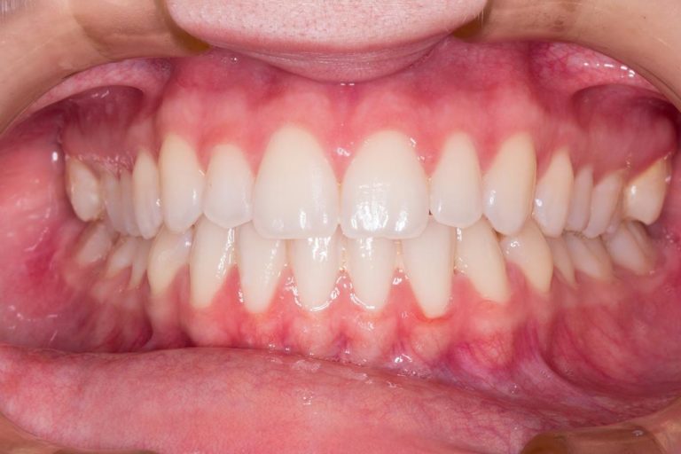 Istotne atuty aparatów Invisalign